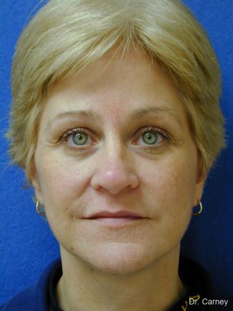 Virginia Beach Facelift 1346 - After Image 1