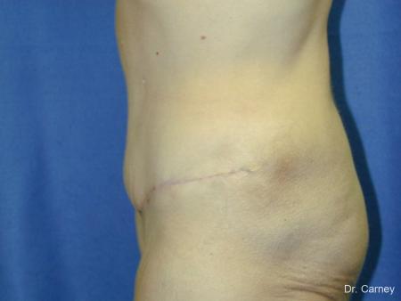 Virginia Beach Tummy Tuck 1249 - After Image 3