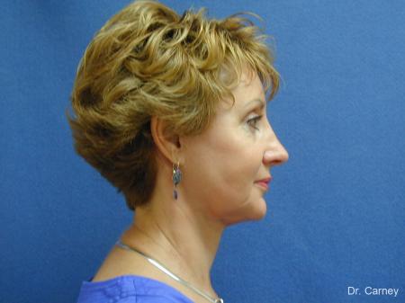 Virginia Beach Brow Lift 1216 - After Image 5