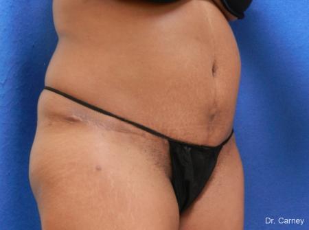 Abdominoplasty: Patient 1 - After Image 2