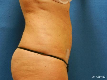 Virginia Beach Liposuction 1279 - After Image 2