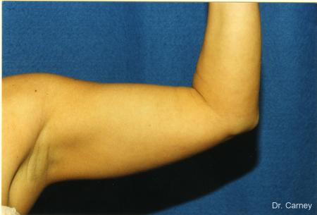 Virginia Beach Brachioplasty 1141 - Before Image 1