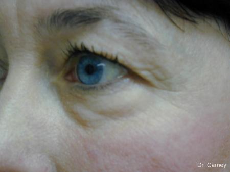 Virginia Beach Eyelid Lift 1139 - Before Image 2