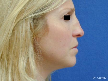 Virginia Beach Rhinoplasty 1343 - Before Image 4