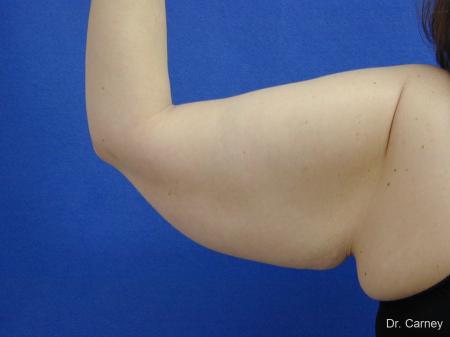 Virginia Beach Brachioplasty 1140 - Before and After Image 3