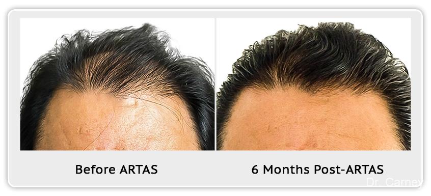 Hair Transplantation: Patient 10 - Before and After 1