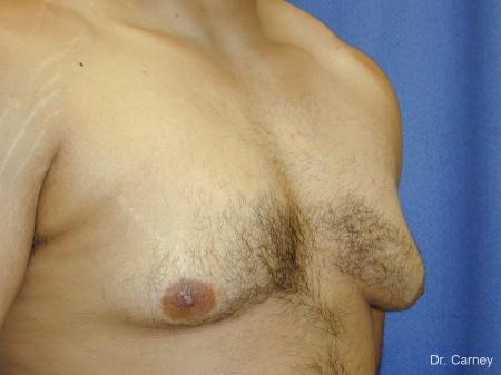 Virginia Beach Gynecomastia 1255 - Before Image 3