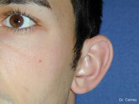 Virginia Beach Otoplasty Earlobe Repair 1222 - Before Image 4