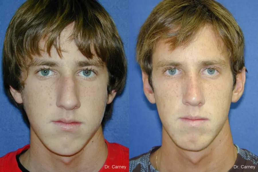 Virginia Beach Rhinoplasty 1219 - Before and After 2