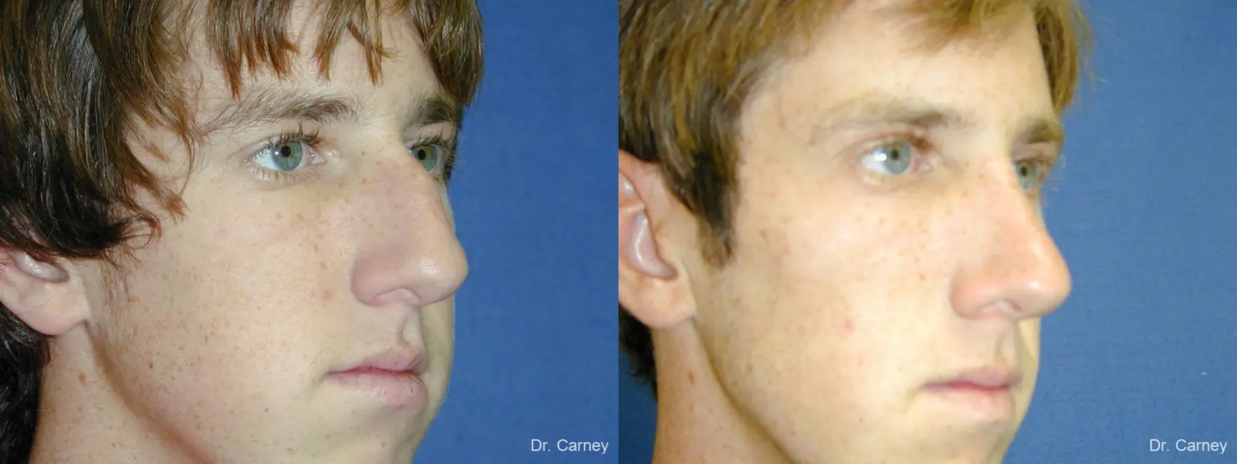 Virginia Beach Rhinoplasty 1219 - Before and After 3