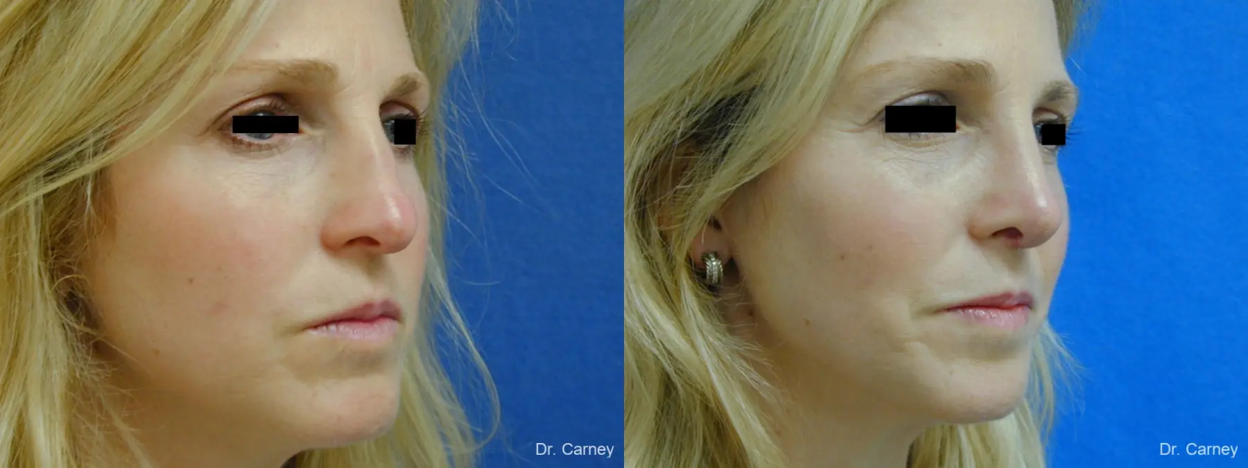 Virginia Beach Rhinoplasty 1343 - Before and After 3