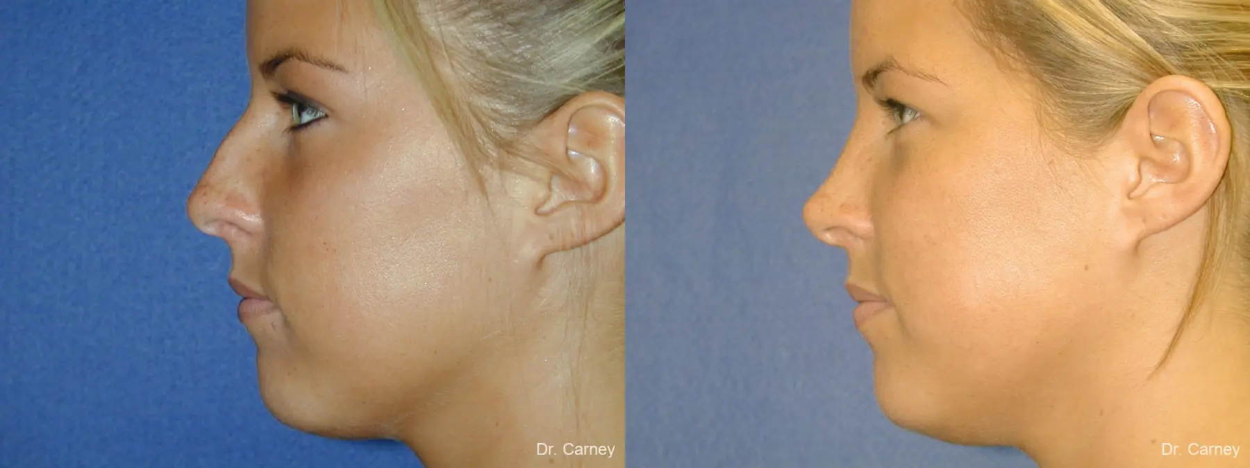Virginia Beach Rhinoplasty 1218 - Before and After 3