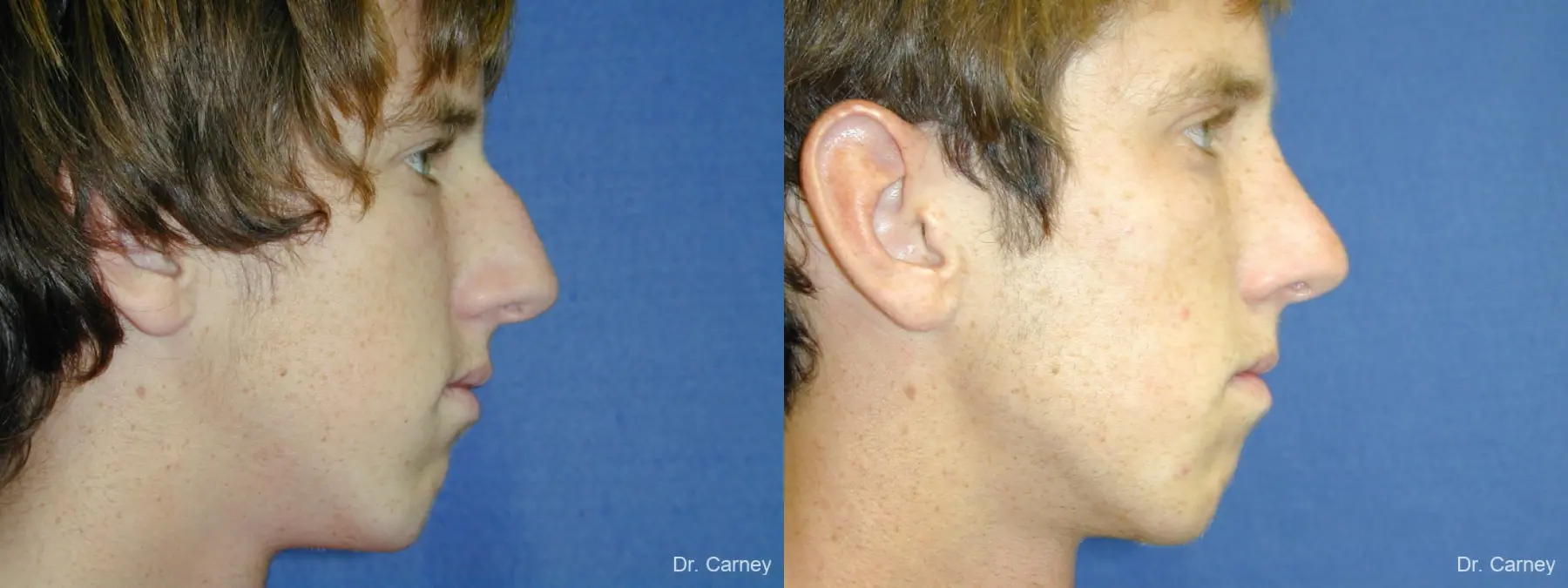 Virginia Beach Rhinoplasty 1219 - Before and After 1