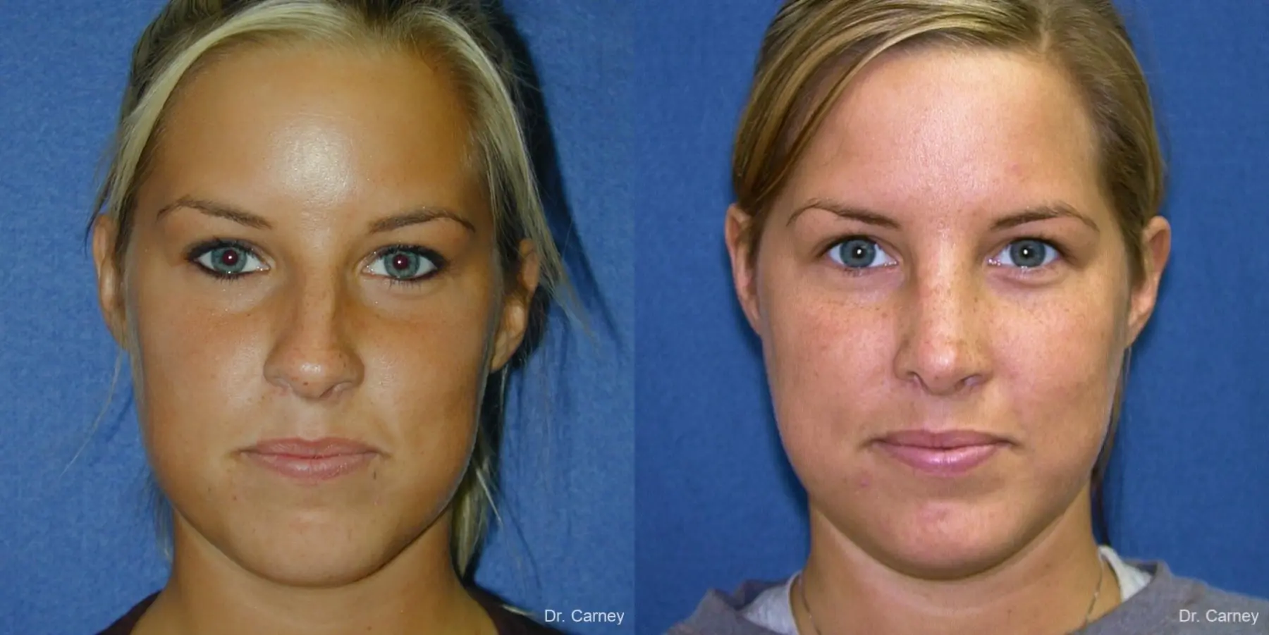 Virginia Beach Rhinoplasty 1218 - Before and After 5