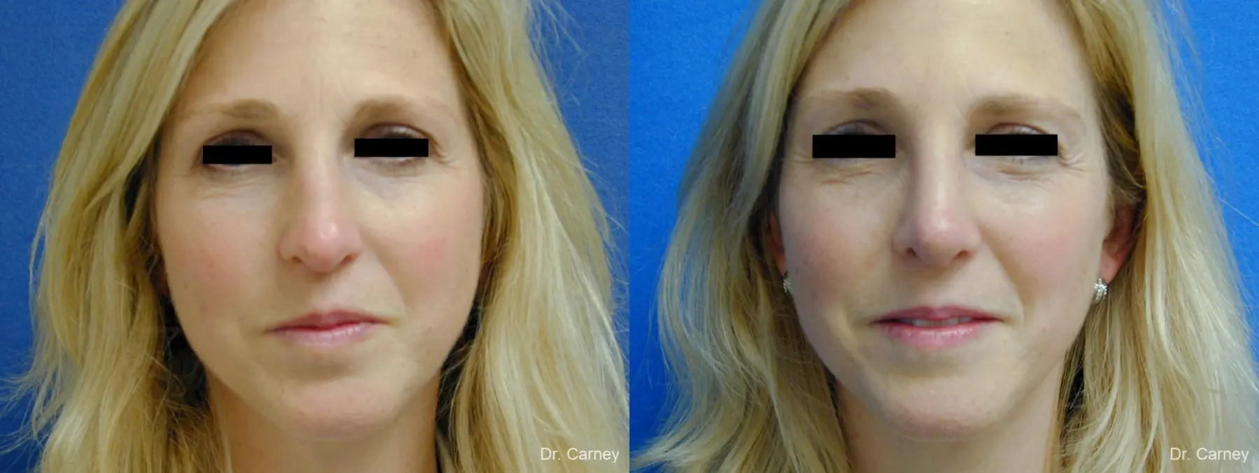 Virginia Beach Rhinoplasty 1343 - Before and After 1