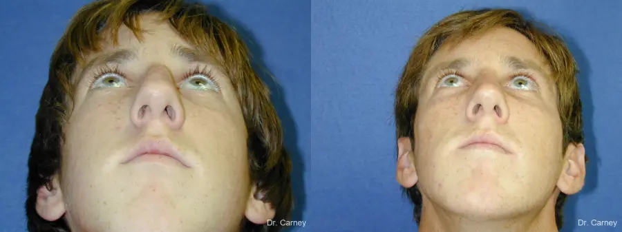 Virginia Beach Rhinoplasty 1219 - Before and After 5