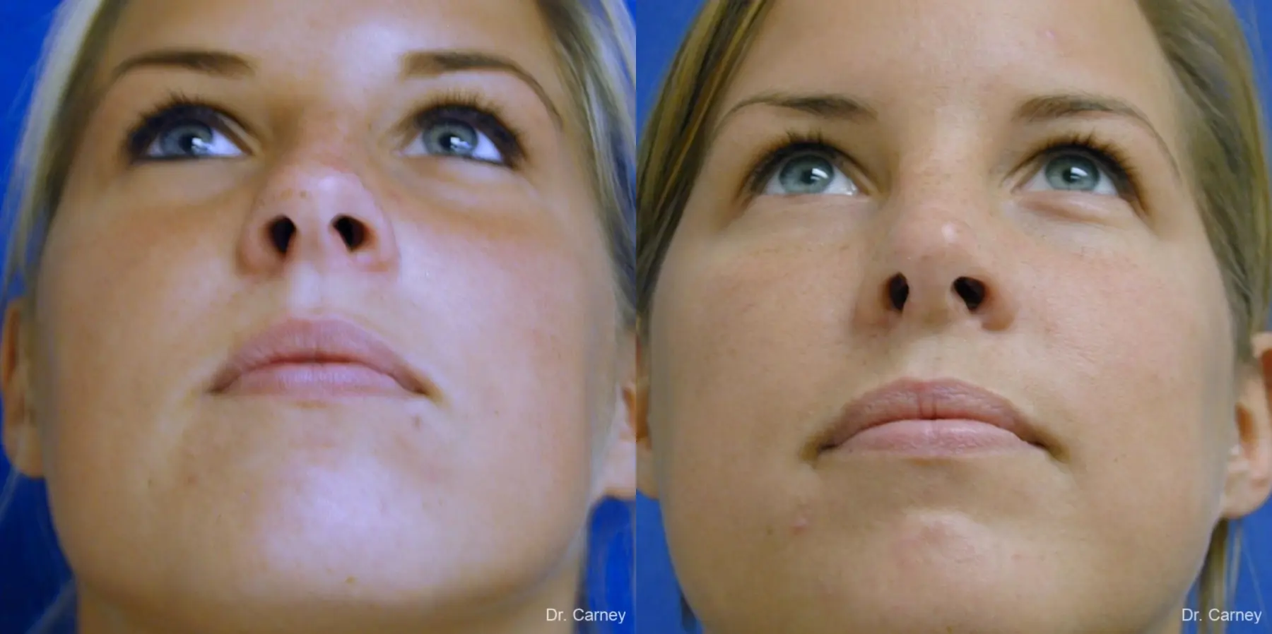 Virginia Beach Rhinoplasty 1218 - Before and After 2
