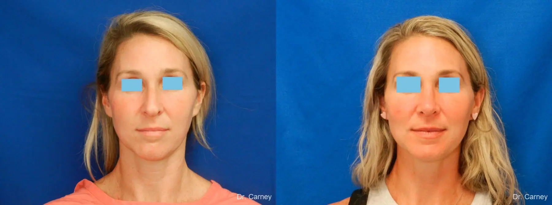 Rhinoplasty: Patient 4 - Before and After  