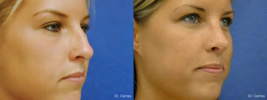 Virginia Beach Rhinoplasty 1218 - Before and After 4
