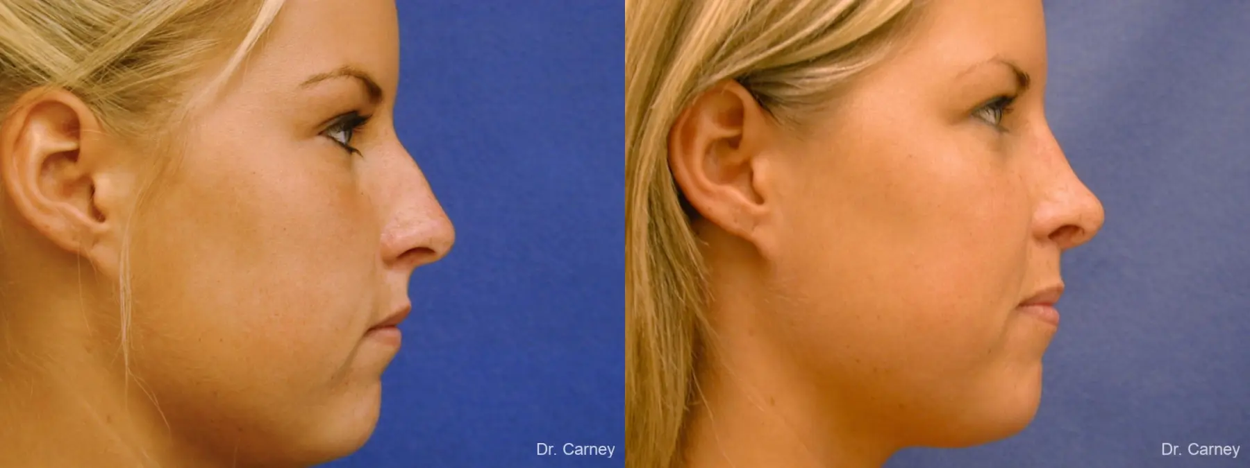 Virginia Beach Rhinoplasty 1218 - Before and After 1