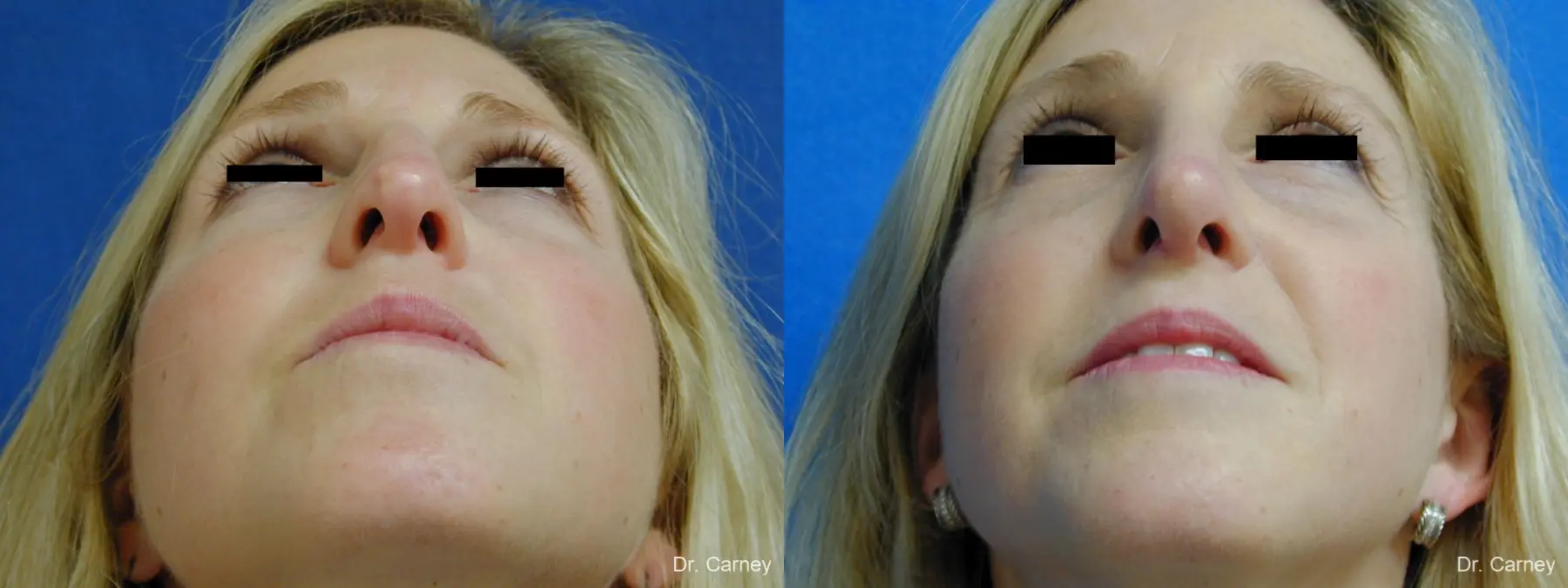 Virginia Beach Rhinoplasty 1343 - Before and After 2