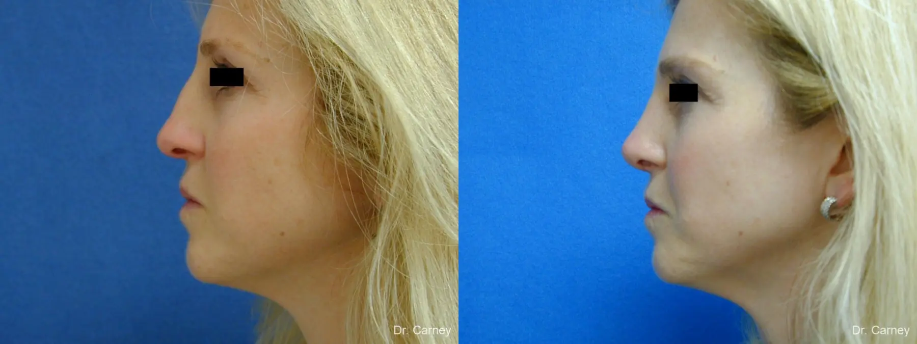 Virginia Beach Rhinoplasty 1343 - Before and After 5