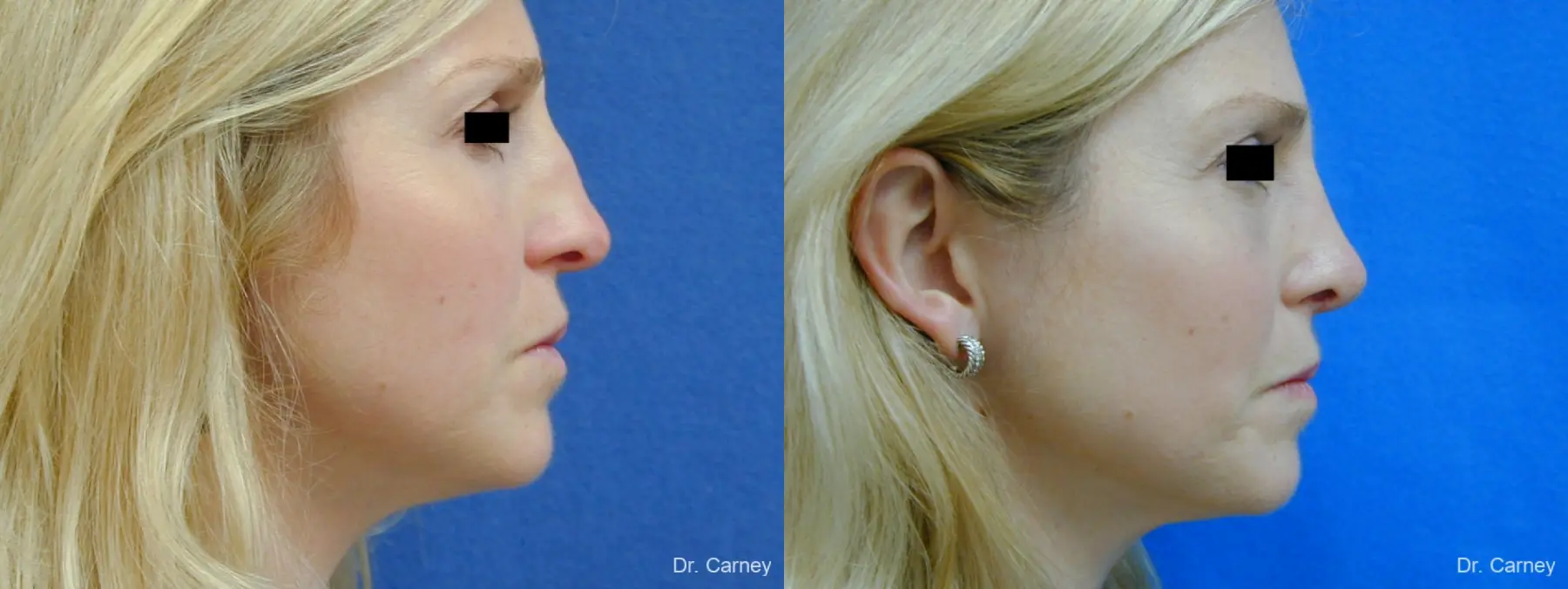Virginia Beach Rhinoplasty 1343 - Before and After 4
