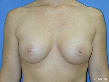 Virginia Beach Breast Augmentation 1081 - After Image 3