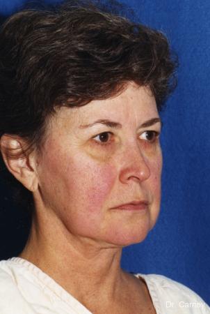 Virginia Beach Laser Skin Resurfacing - Face 1259 - Before Image 1