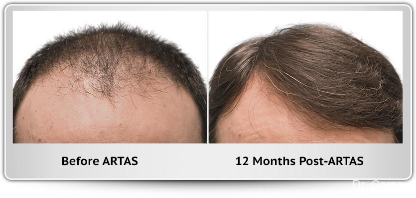 Hair Transplantation: Patient 3 - Before and After 1