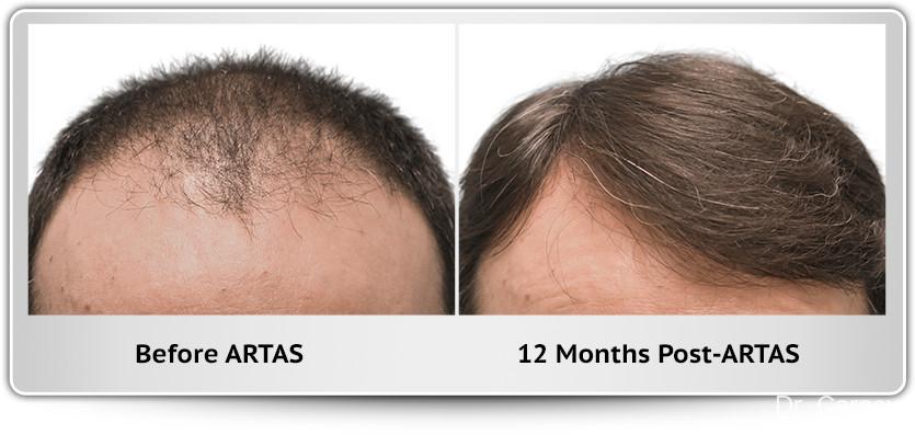 Hair Transplantation: Patient 3 - Before and After  