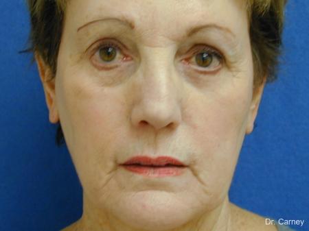 Virginia Beach Facelift 1133 - Before Image 2