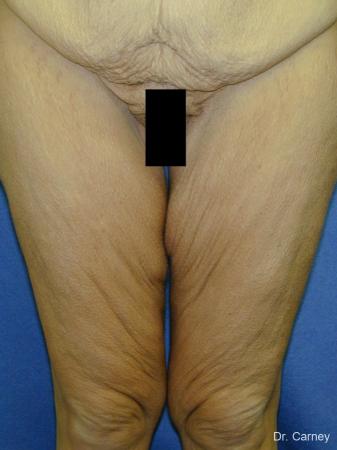Virginia Beach Thigh Lift 1252 - Before and After Image 2