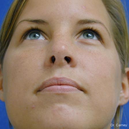 Virginia Beach Rhinoplasty 1218 - After Image 2