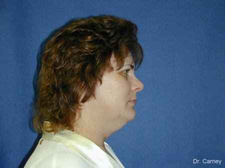 Virginia Beach Facelift 1136 - Before Image 2