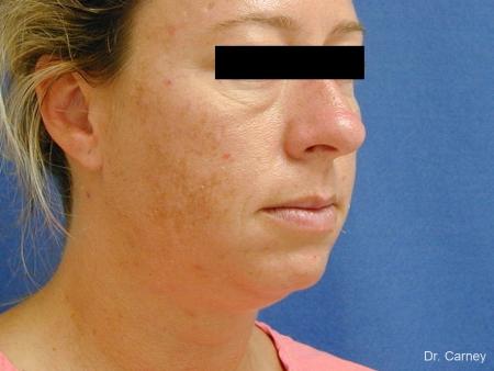 Virginia Beach Neck Lift 1267 - Before Image 3