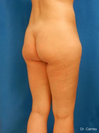 Brazilian Butt Lift: Patient 7 - Before Image 2