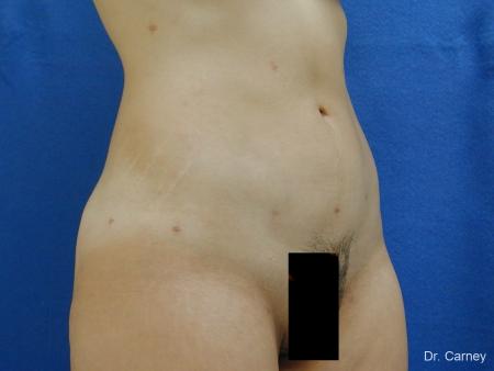 Virginia Beach Liposuction 1276 - After Image 2