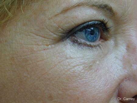 Virginia Beach Brow Lift 1266 - After Image 4