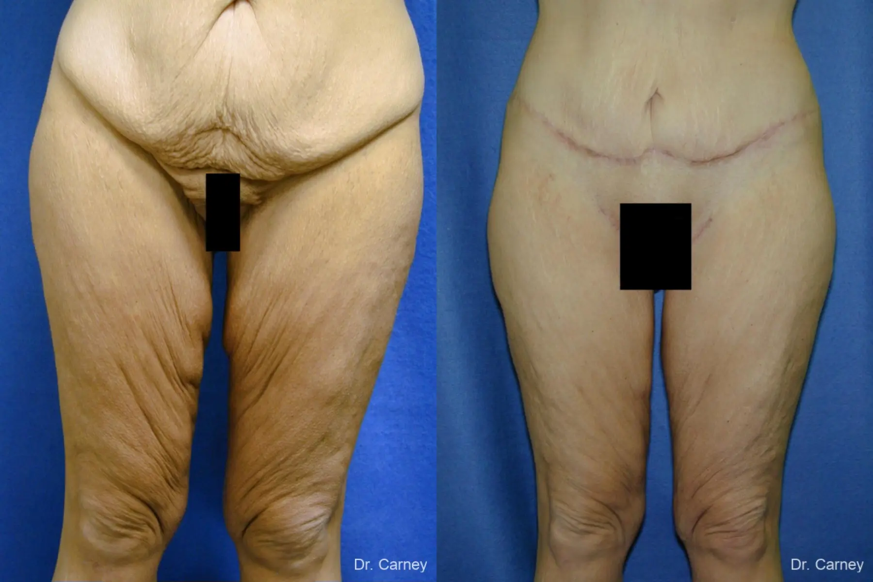 Virginia Beach Thigh Lift 1252 - Before and After