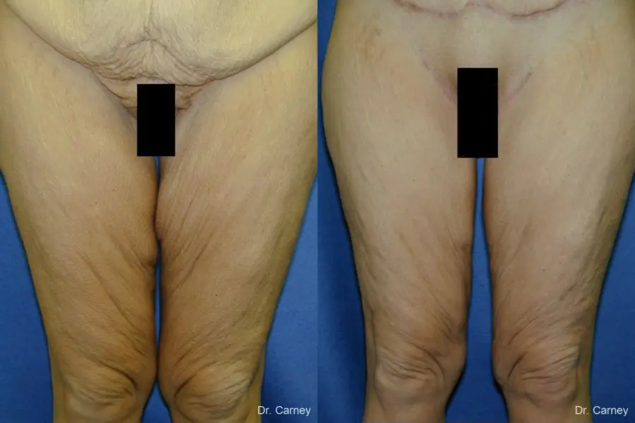 Virginia Beach Thigh Lift 1252 - Before and After 2