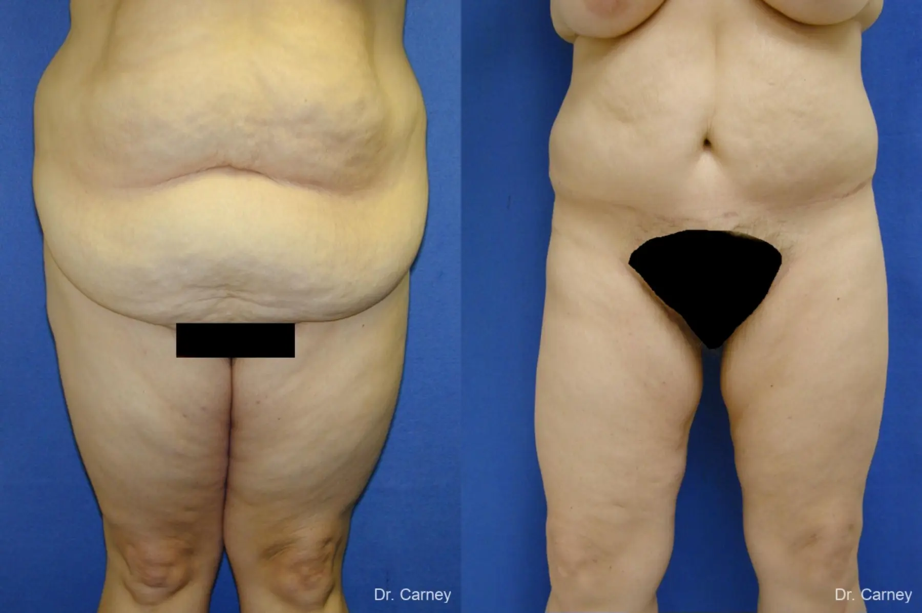 Virginia Beach Thigh Lift 1253 - Before and After