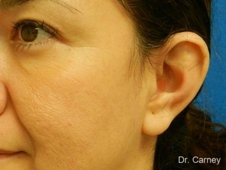Virginia Beach Otoplasty Earlobe Repair 1225 - Before and After Image 4