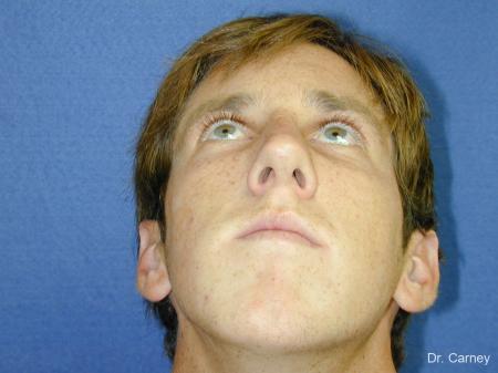 Virginia Beach Rhinoplasty 1219 - After Image 5