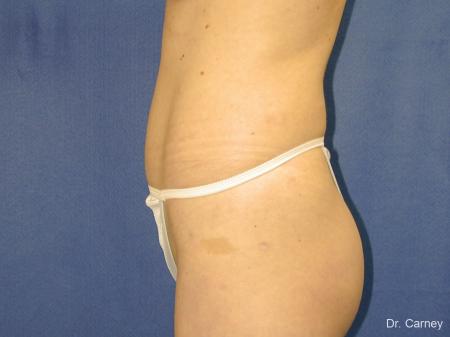 Virginia Beach Liposuction 1280 - After Image 3