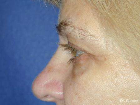 Virginia Beach Brow Lift 1345 - Before and After Image 5