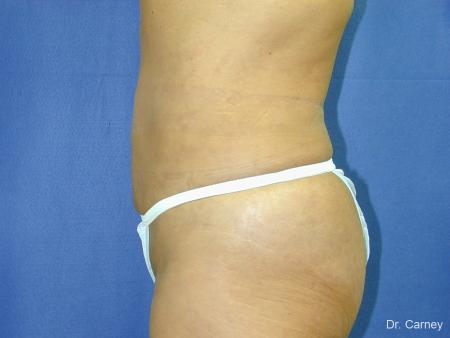 Virginia Beach Liposuction 1213 - After Image 2