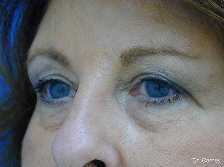 Virginia Beach Eyelid Lift 1129 - After Image 3