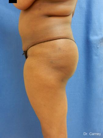Brazilian Butt Lift: Patient 5 - After Image 1