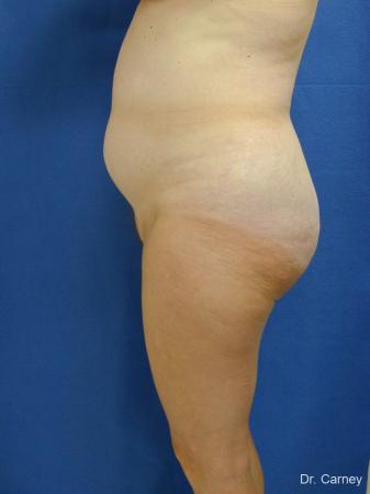 Virginia Beach Liposuction 1213 - Before Image 3